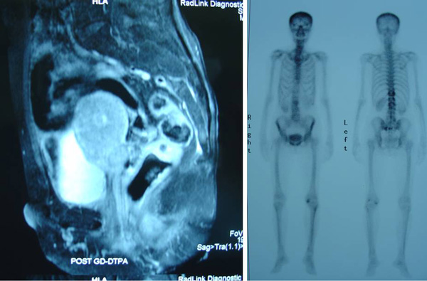 Composite-CT-and-bone