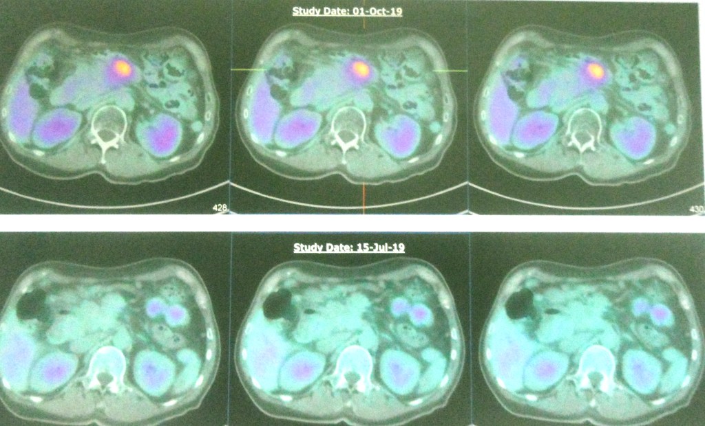 Pancreas SH singapore2.jpg