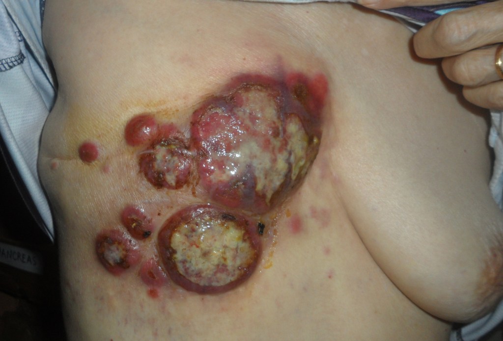 Rottenbreast LiuEdit.jpg